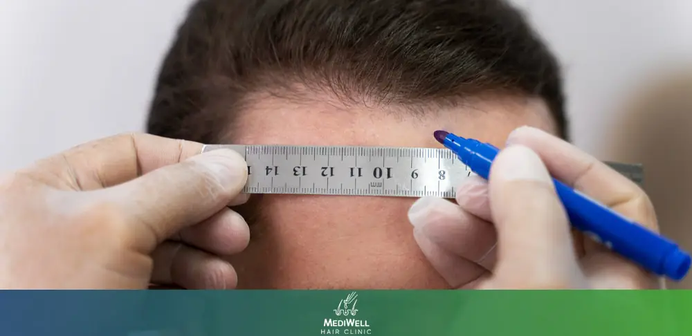 3000 Grafts Hair Transplant Cost