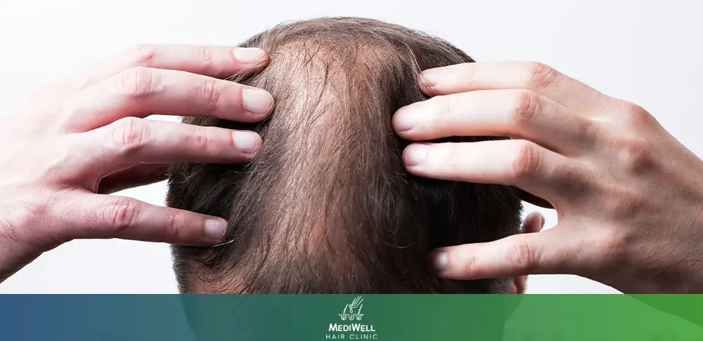 5000 Grafts Hair Transplant