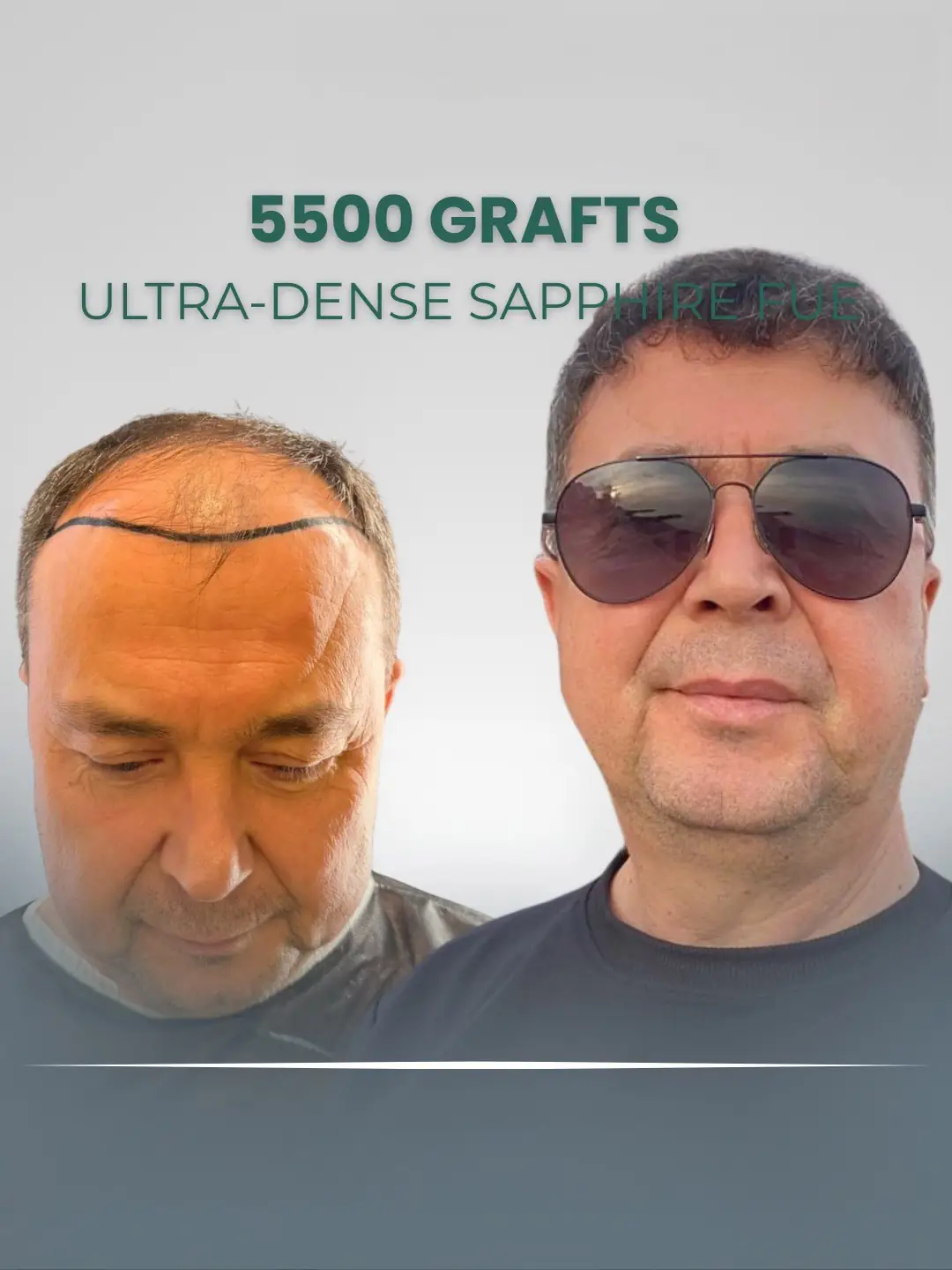5500 Grafts Sapphire FUE Hair Transplant