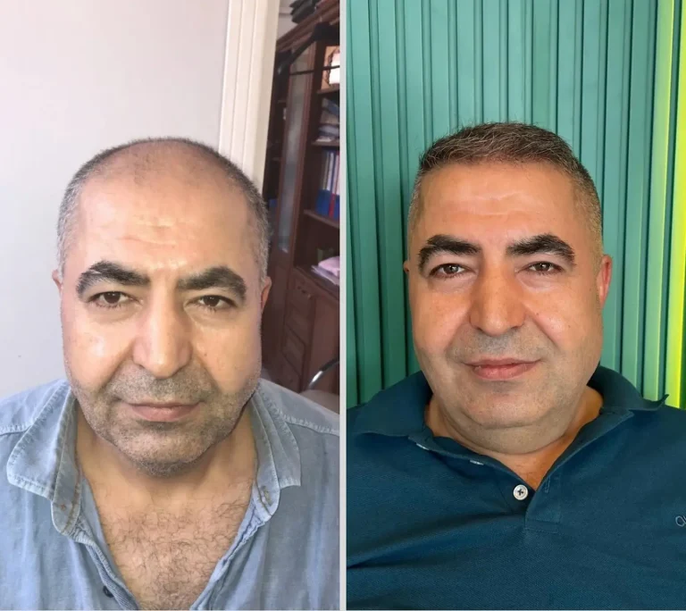 6 months 5500 grafts