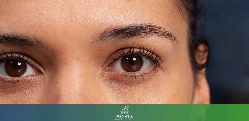 7 Things to Know Before Getting an Eyebrow Transplant