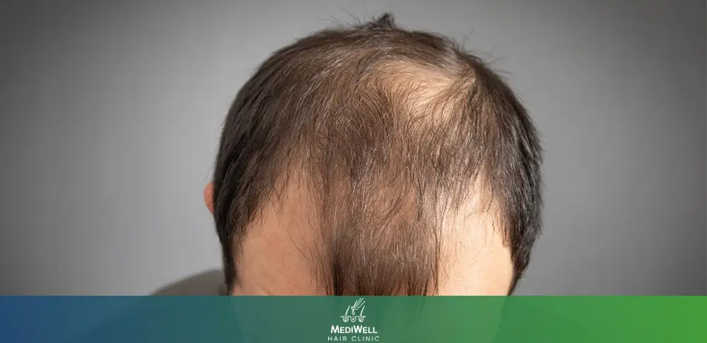 Crown Hair Loss Close-up