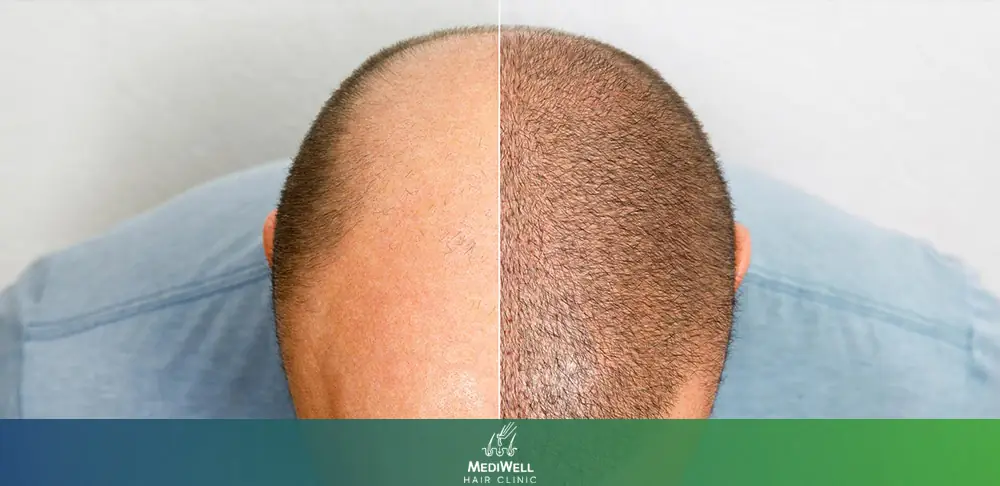 Crown Whorl vs Bald Spot