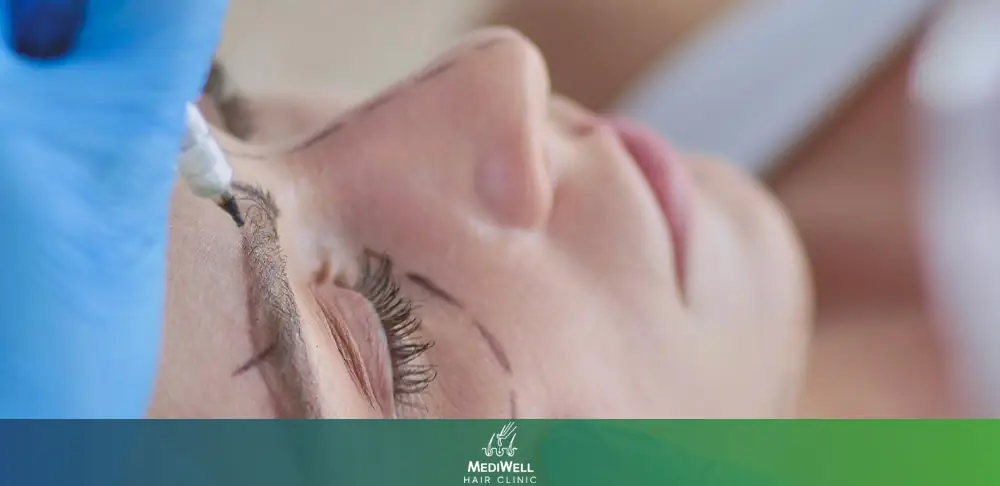 Eyebrow Reconstruction After Scarring or Injury