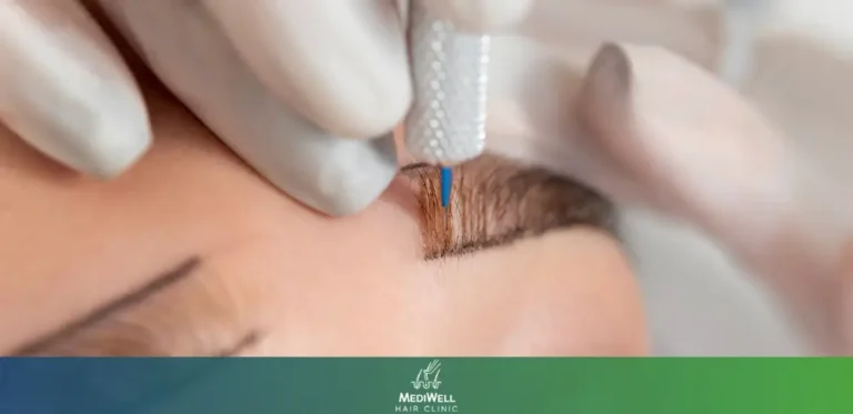 Eyebrow Transplant Cost UK