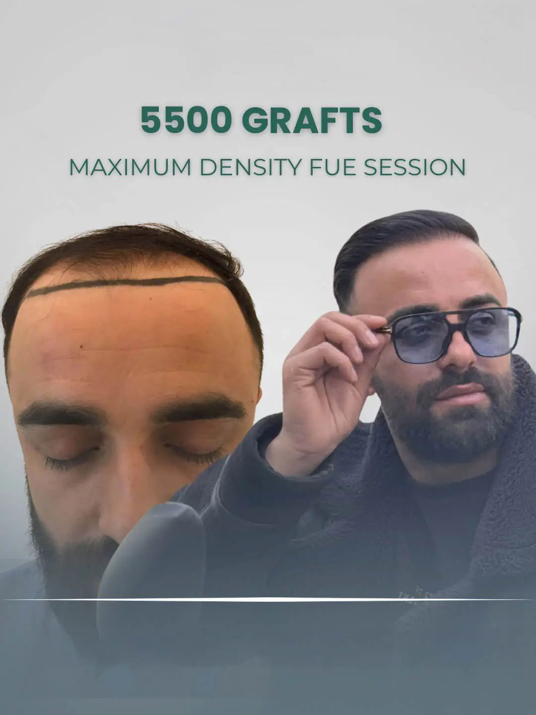 FUE Hair Transplant London 5500 Grafts