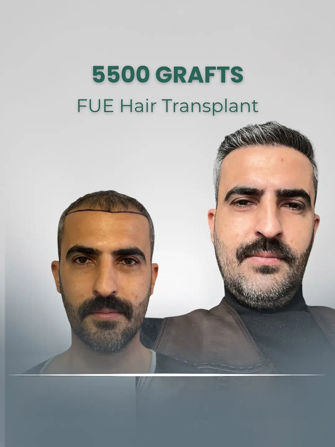 FUE Hair Transplant 5500 Grafts London Clinic