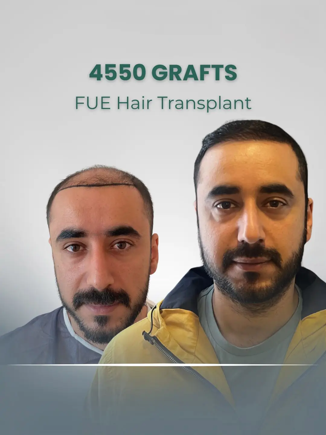 FUE Hair Transplant Clinic London 4550 Grafts
