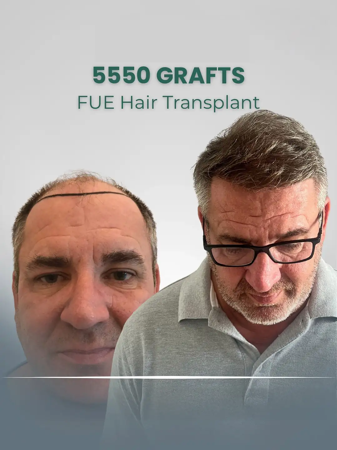 FUE Hair Transplant Clinic London 5500 Grafts