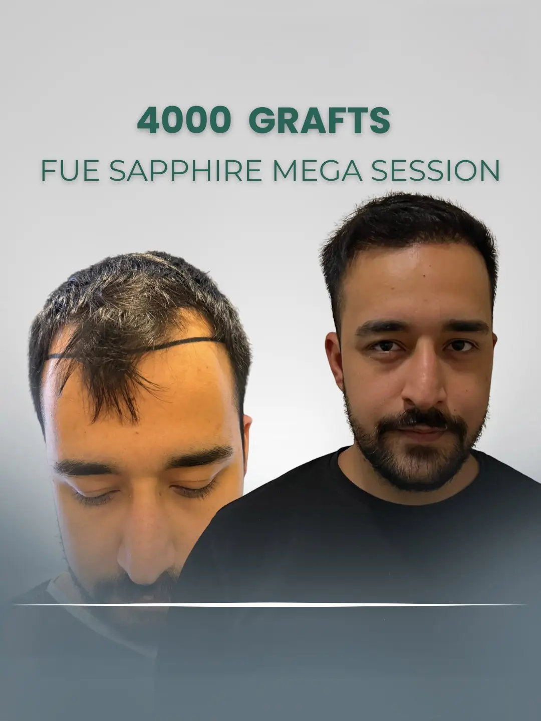 Sapphire Fue Hair Transplant Clinic 4000 Grafts