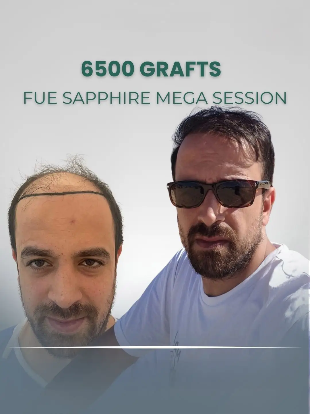 FUE Sapphire Mega Session 6500 Grafts