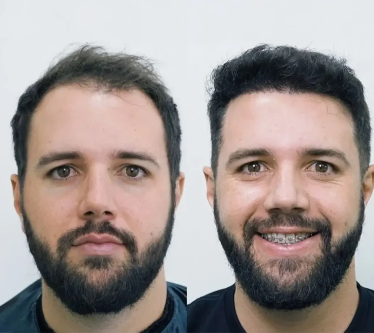 Hair Transplant 3500 grafts 5 months