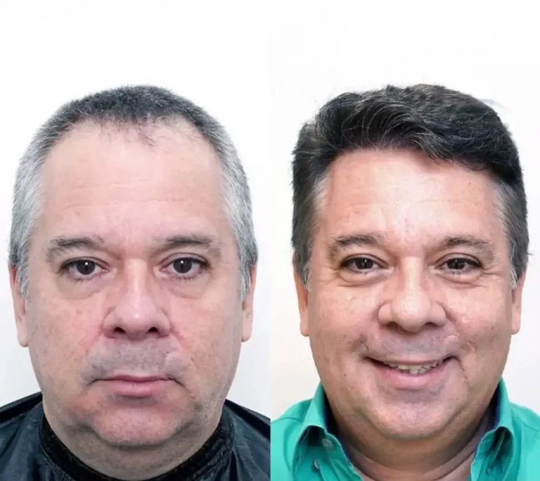 Hair Transplant 3600 grafts 9 months