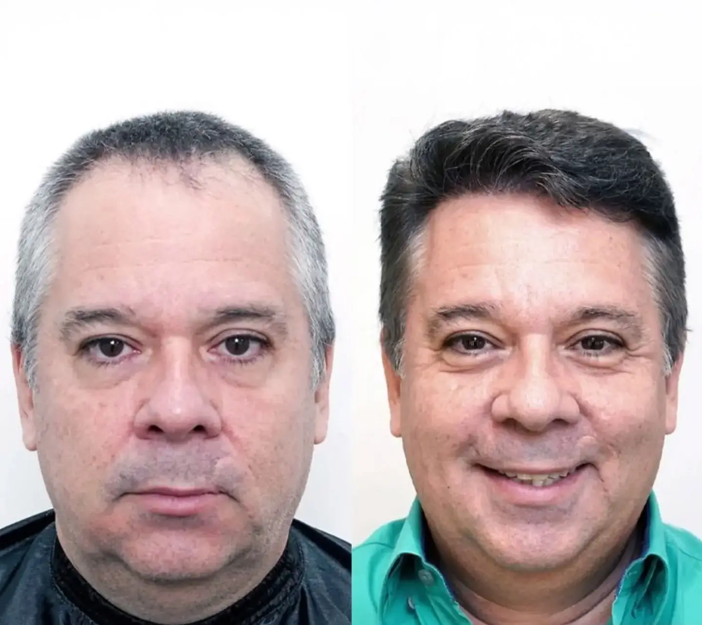 Hair Transplant 3600 grafts 9 months