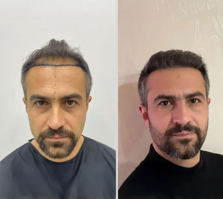 Hair Transplant 4000 Grafts 6 months