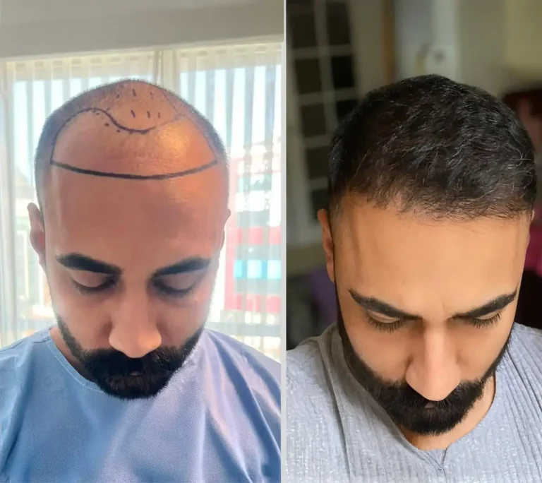 Hair Transplant 4000 graft 6 months