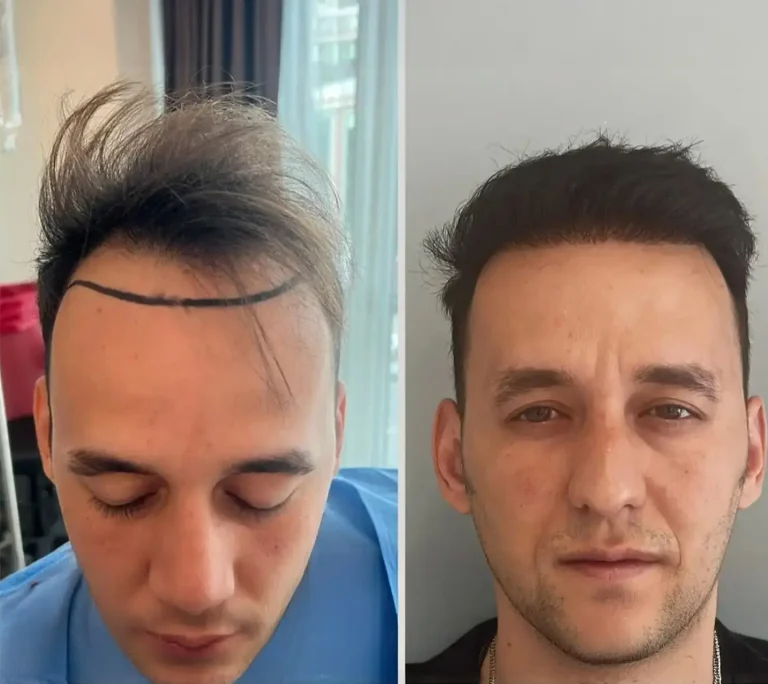 Hair Transplant 4500 grafts 6 months