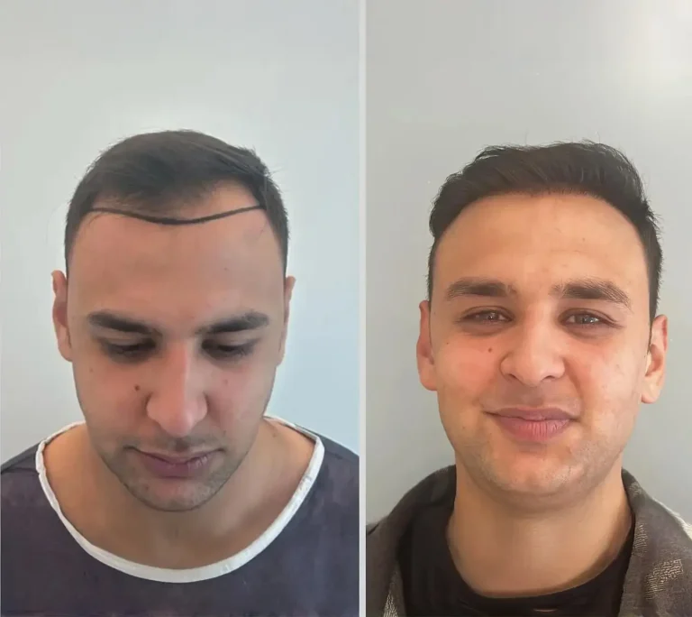 Hair Transplant 4500 hair grafts 6 months