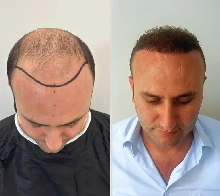 Hair Transplant 5000 grafts 6 months