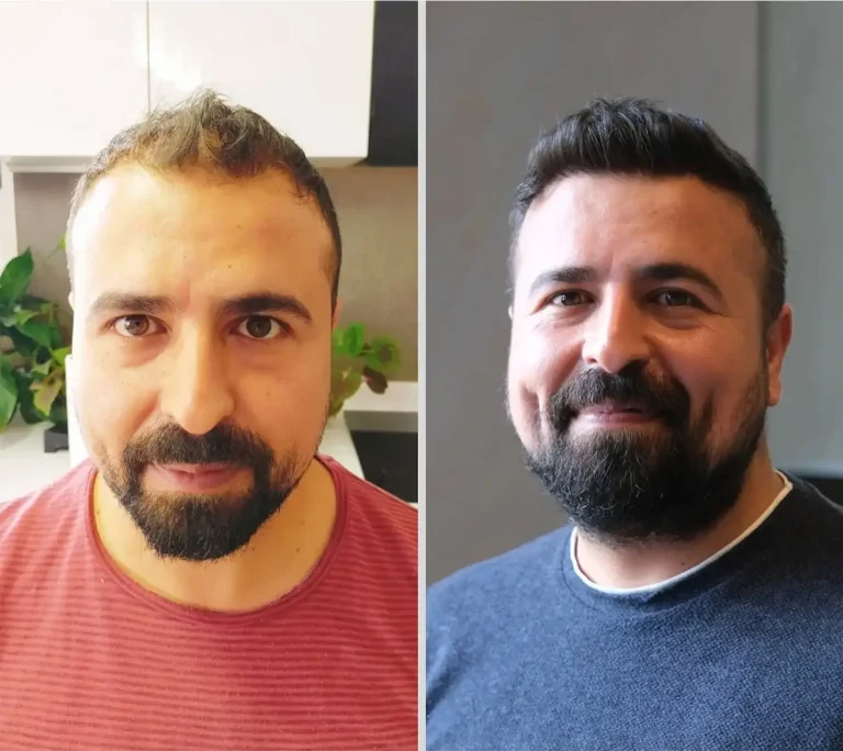 Hair Transplant 5000 grafts 6 months later