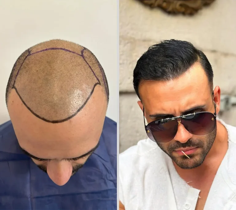Hair Transplant 5000 grafts 7 months