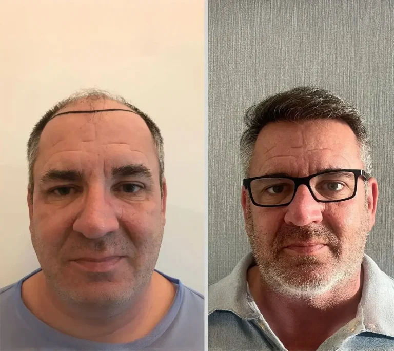 Hair Transplant 5000 grafts hair transplant clinic london