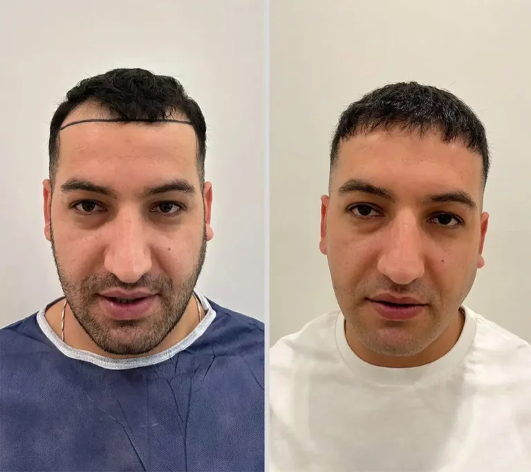 Hair Transplant 5500 grafts 6 months
