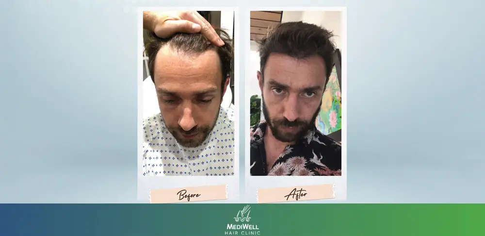 Hair Transplant Techniques Used in Our Clinic