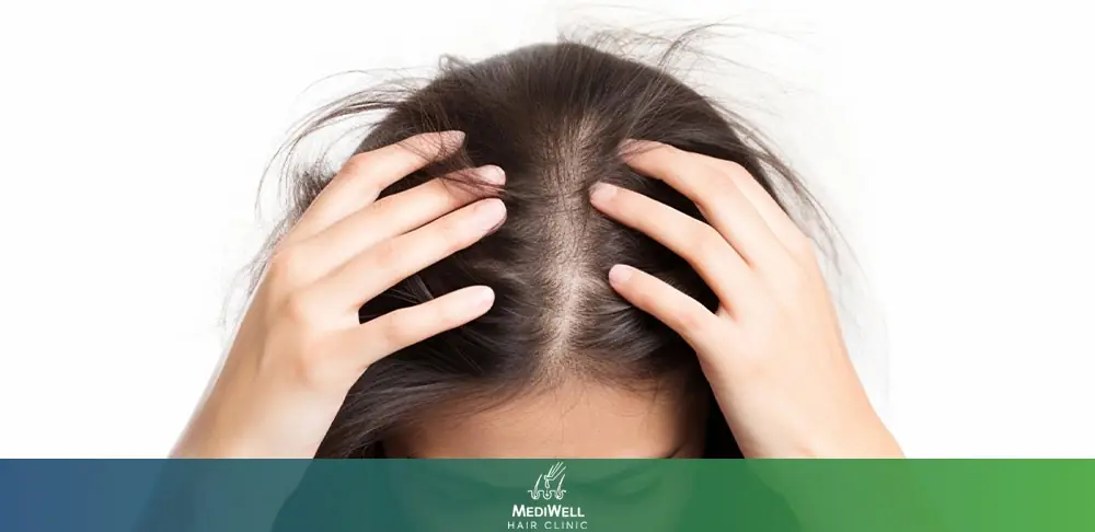 Hair Transplant for Women