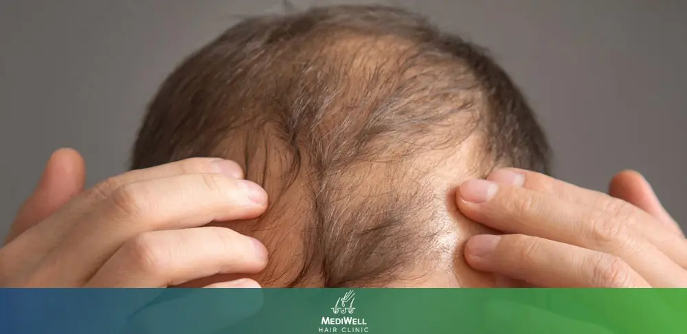 How DHT Causes Crown Hair Loss