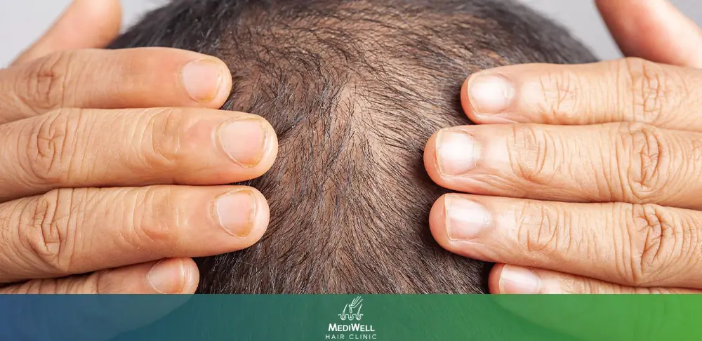 How long does a hair transplant last?