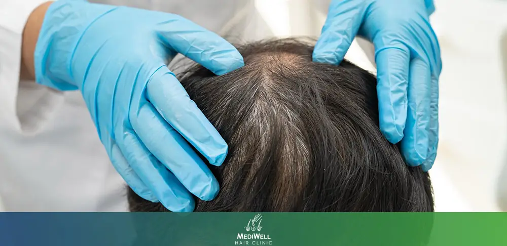 How Long Does a Hair Transplant Last?