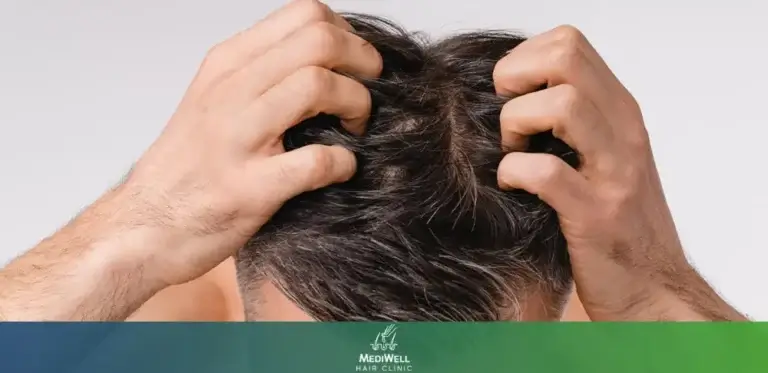 Itching After Hair Transplant