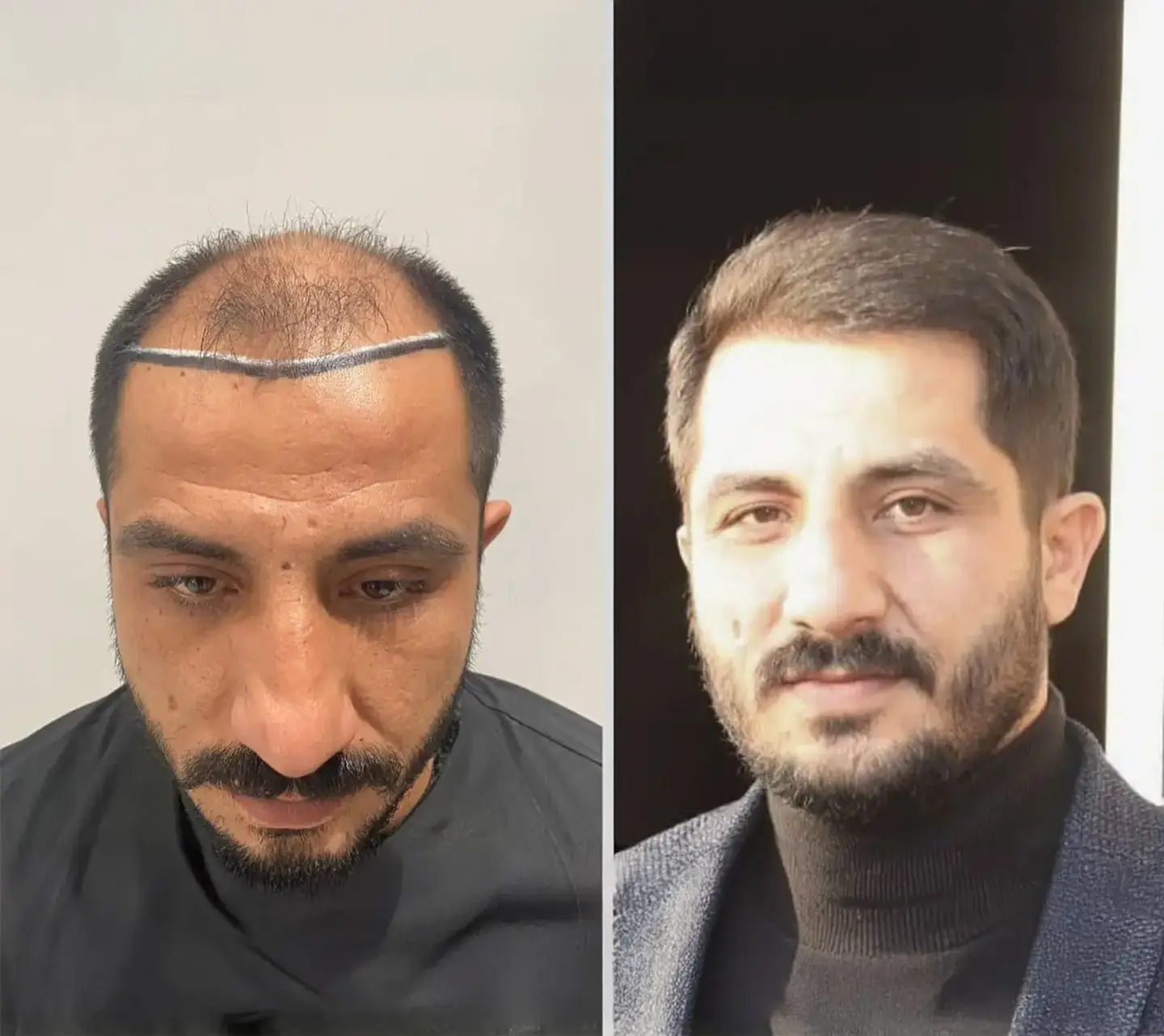 Hair Transplant Cost UK 9 London Clinic 4500 grafts hair transplant 6 months