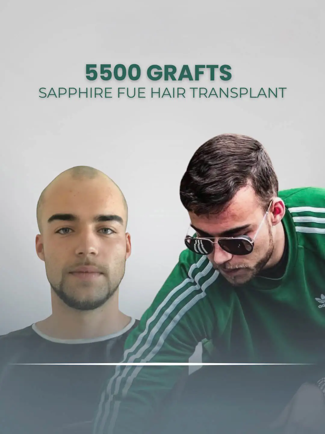 London Hair Transplant Clinic 5500 Grafts Sapphire FUE