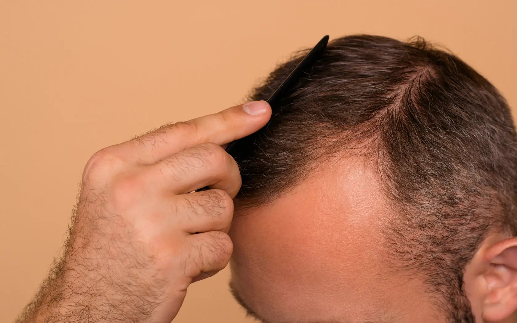 London Hair Transplant Clinic Hybrid