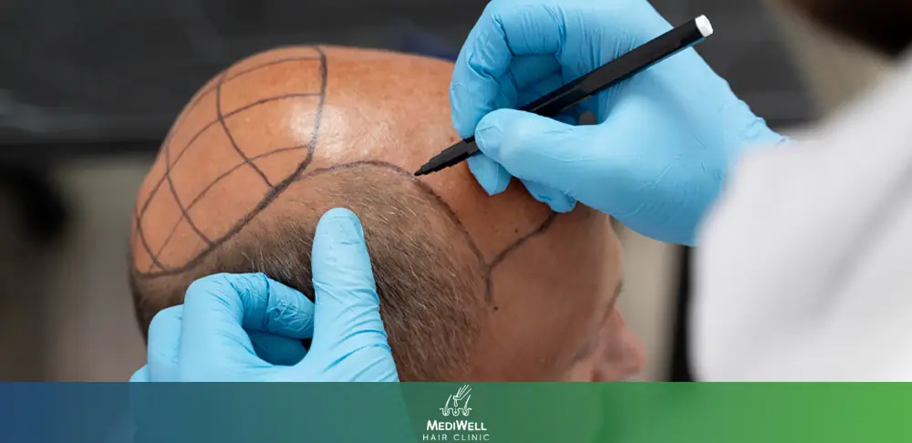 London Hair Transplant Clinic