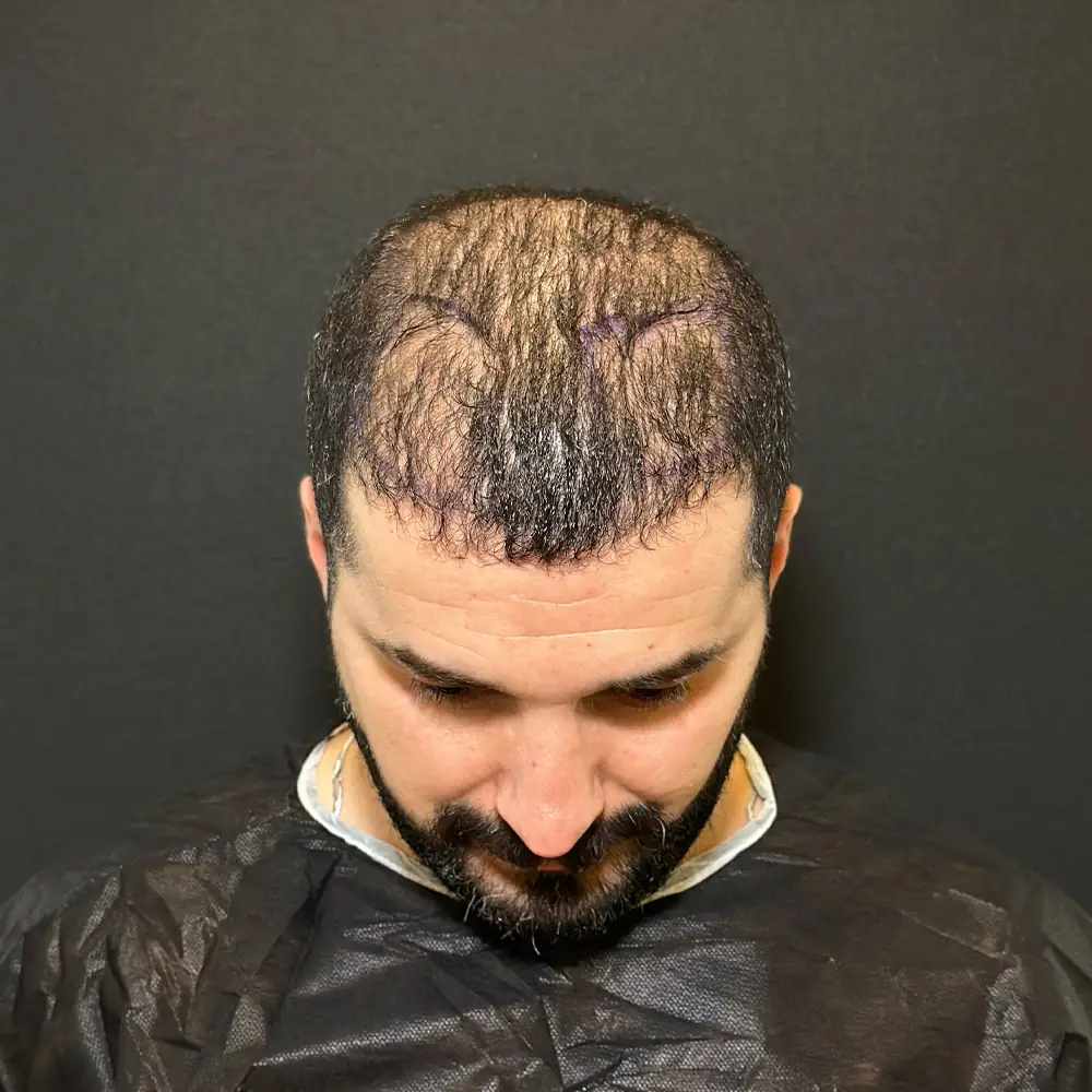 Mr Ali Hair Transplant Before Photo 2