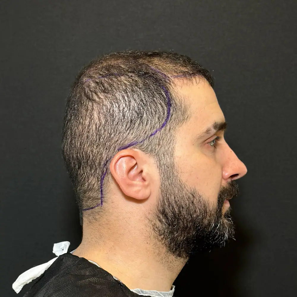 Mr Ali Hair Transplant Before Photo 3