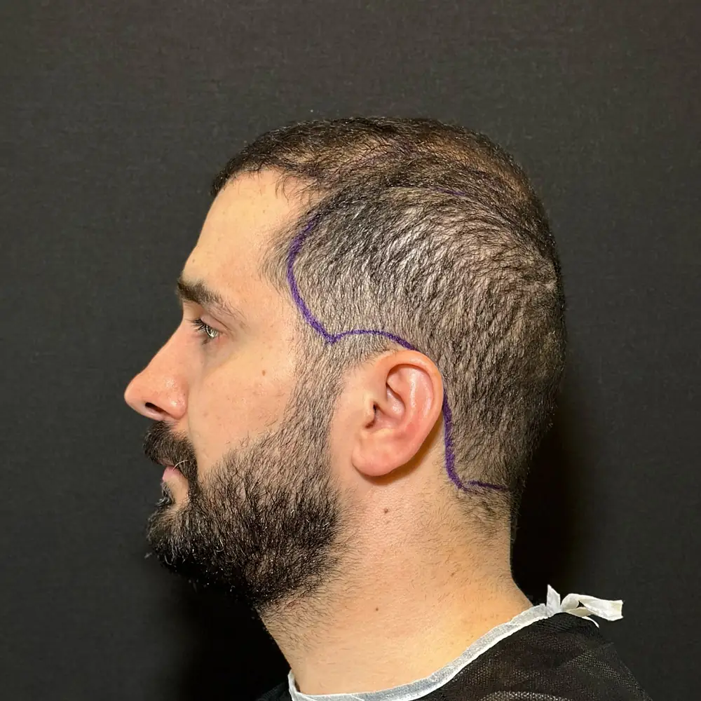 Mr Ali Hair Transplant Before Photo 4