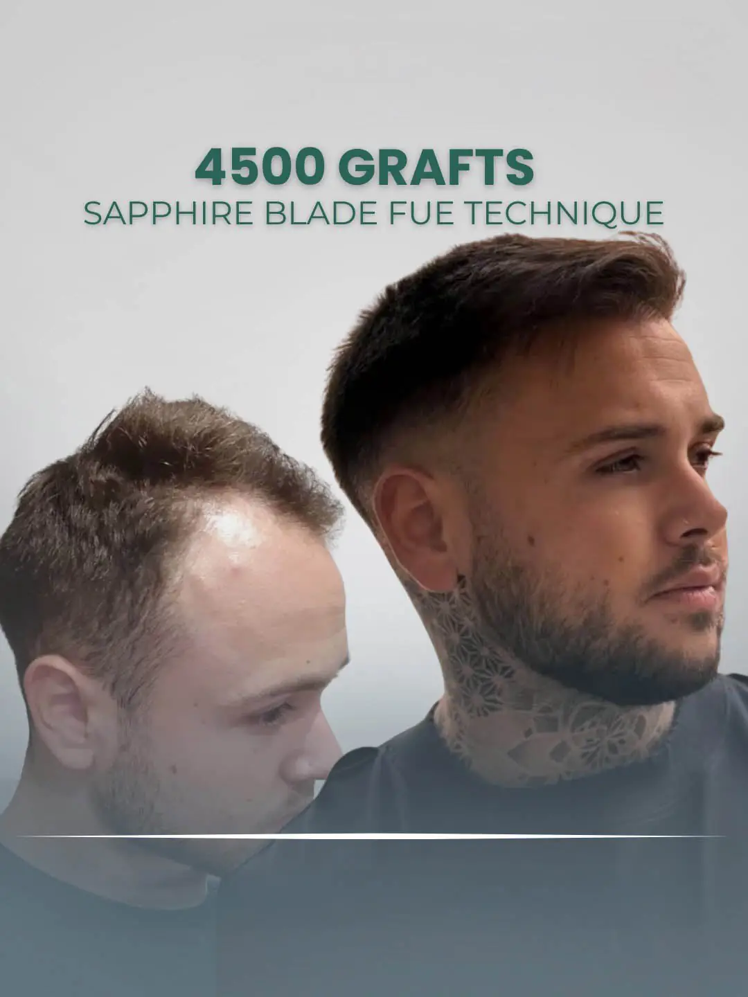Sapphire Blade Fue Hair Transplant 4500 Grafts