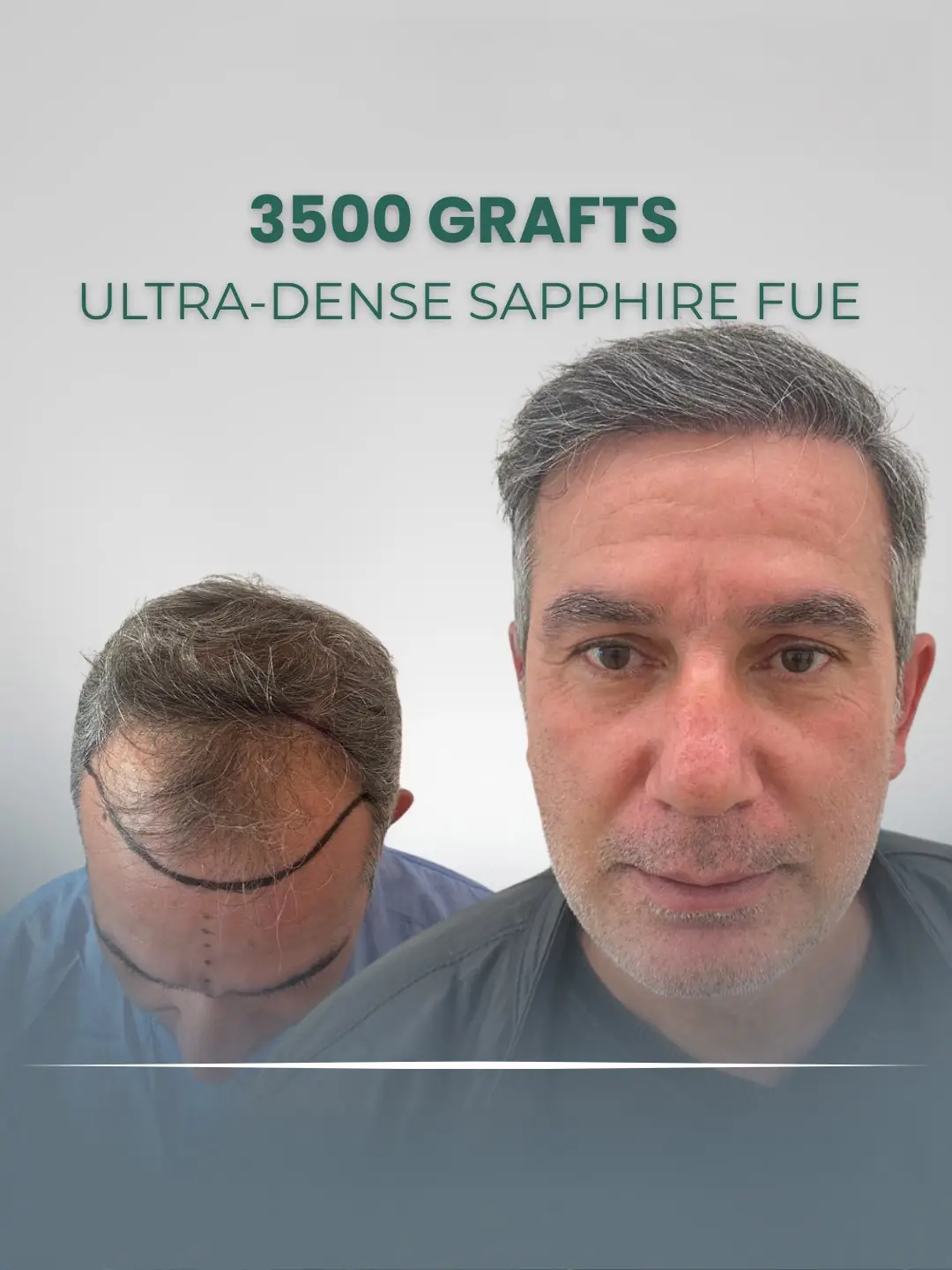 Sapphire FUE Hair Transplant Clinic London England