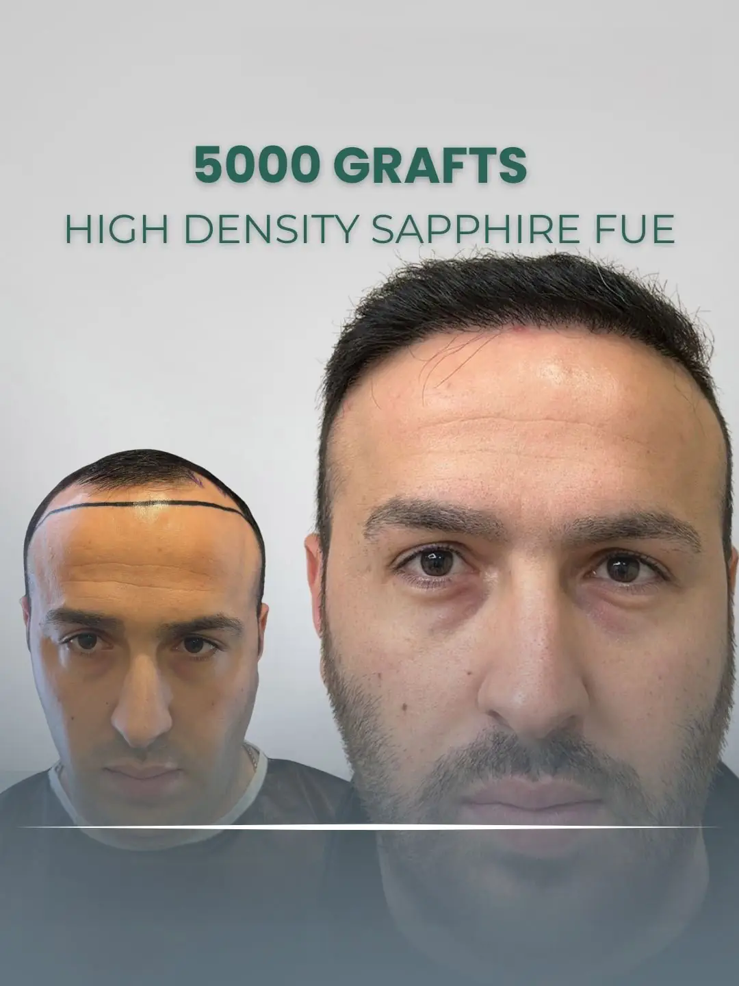 Sapphire FUE Hair Transplant Clinic London 5000 Grafts