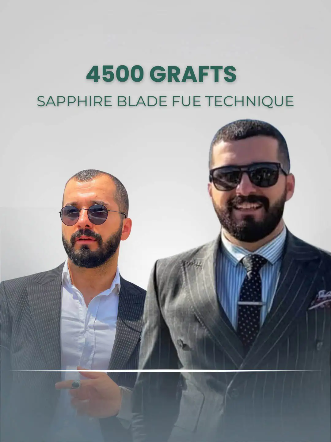 Sapphire Hair Transplant London 4500 Grafts