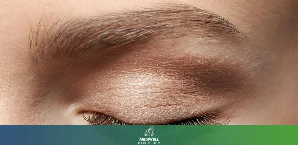 What Should You Expect From an Eyebrow Transplant After 1 Year?