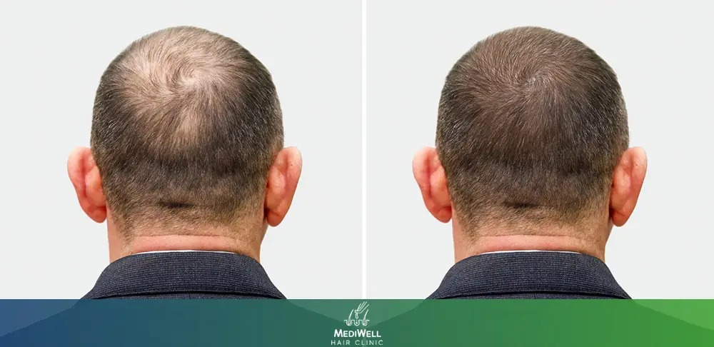 What is a Hair Graft