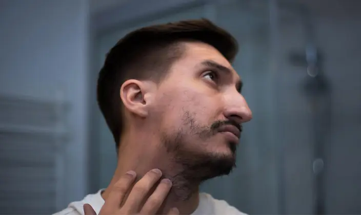 Beard and Moustache Transplant