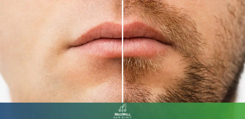 beard transplant cost before after