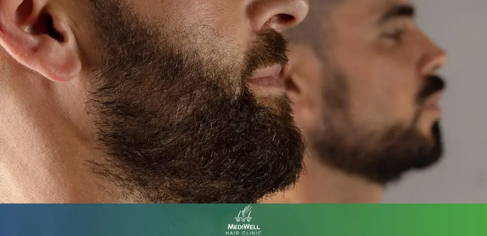 Beard Transplant