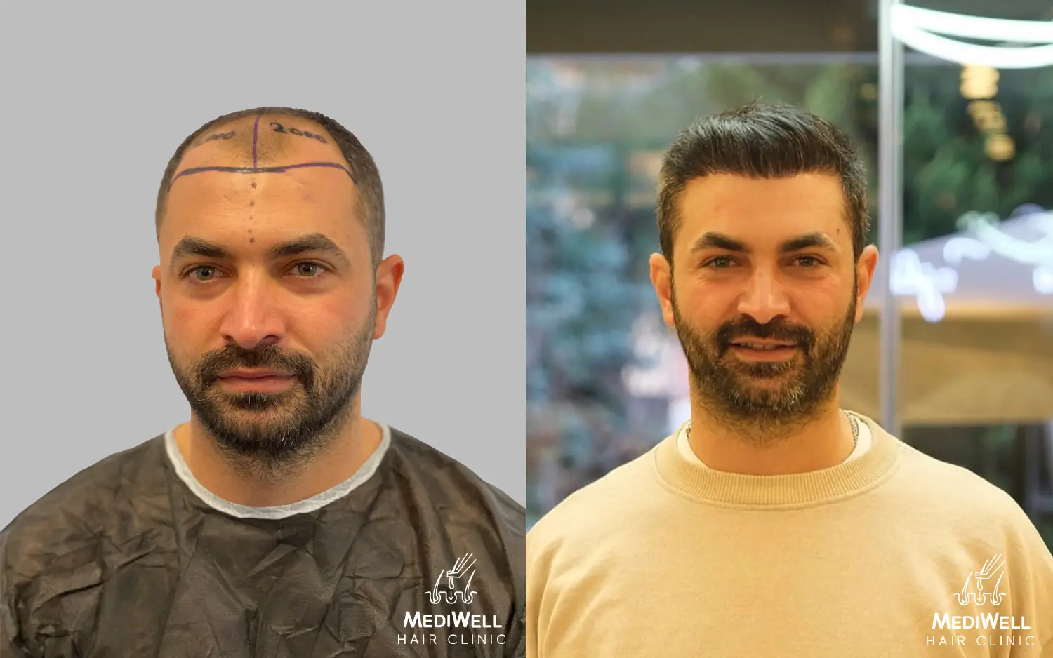 dhi hair transplant before after